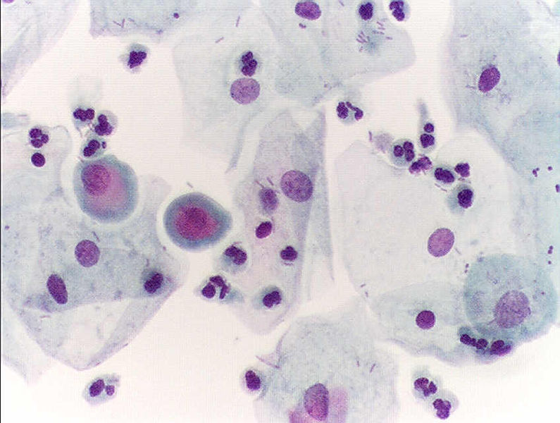 Urine Cytology: यूरिन सायटोलॉजी क्या है?