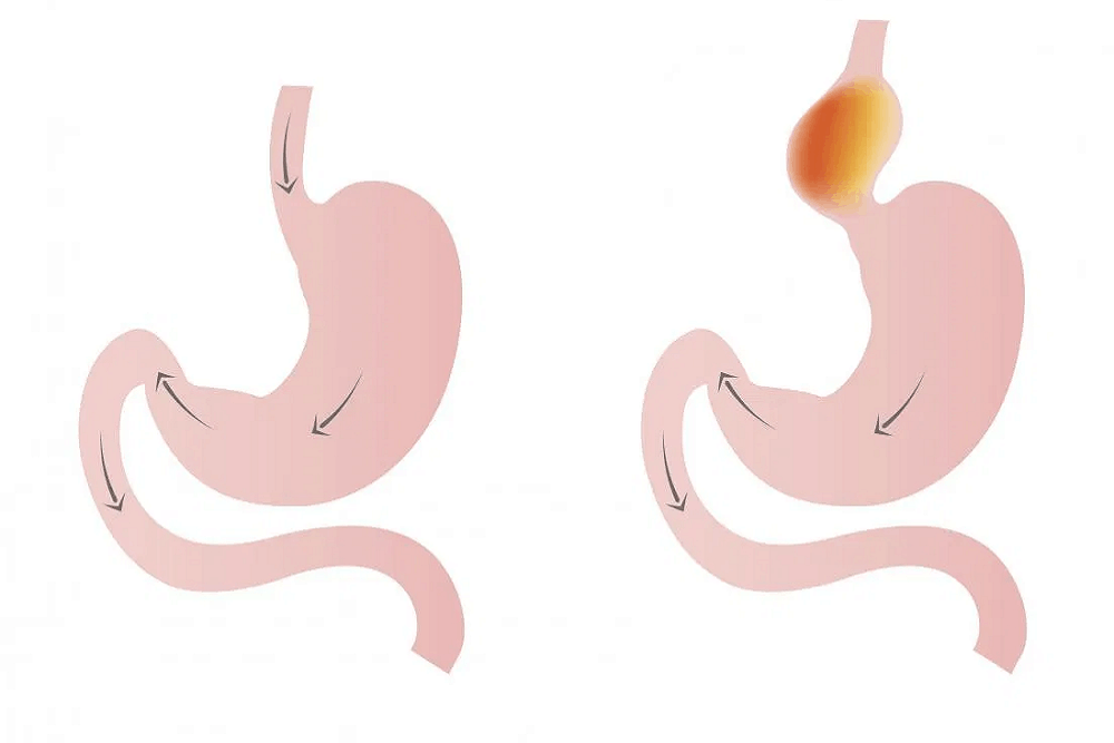 हाइटल हर्निया (Hiatal Hernia) : एसिडिटी और बदहजमी को न करें नजरअंदाज