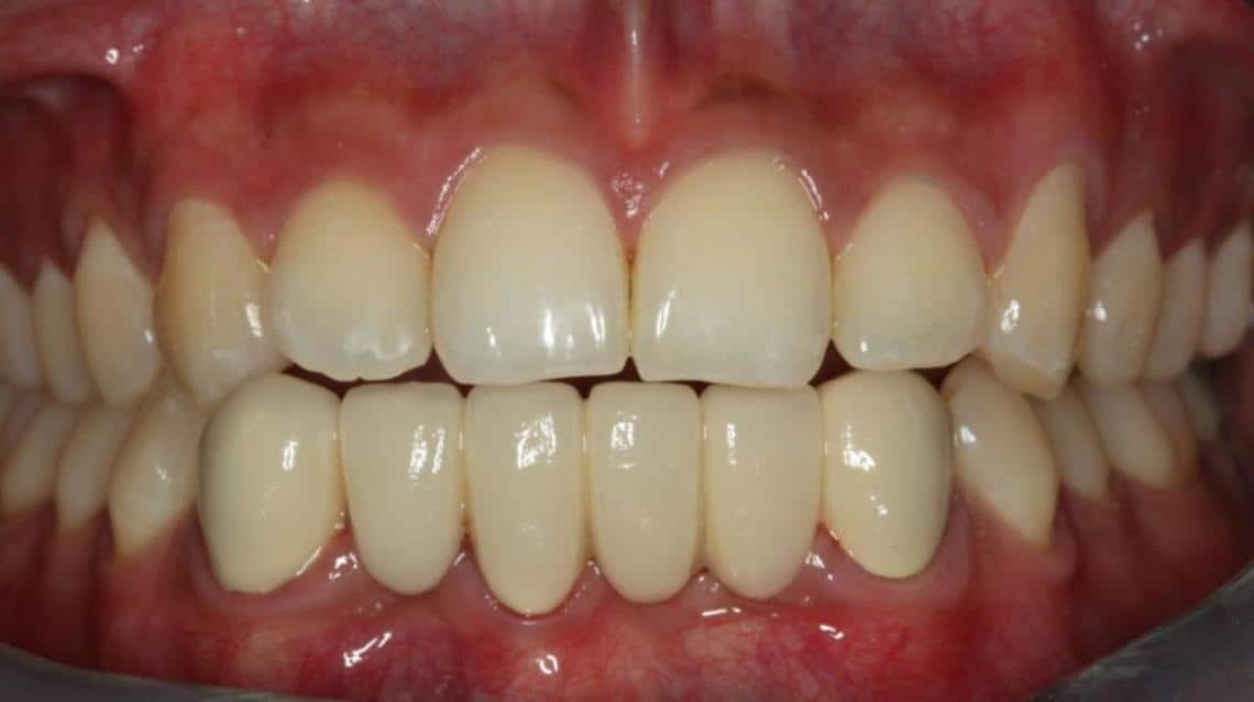 पायरिया (Pyorrhoea) क्या है और ये क्यों होता है?