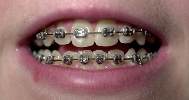 दांतों में तार लगाना है तो पहले ये 5 बातें जानना है जरूरी