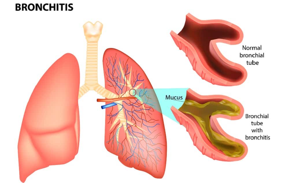 Bronchitis: ब्रोंकाइटिस क्या है? जानिए इसके कारण, लक्षण और उपाय