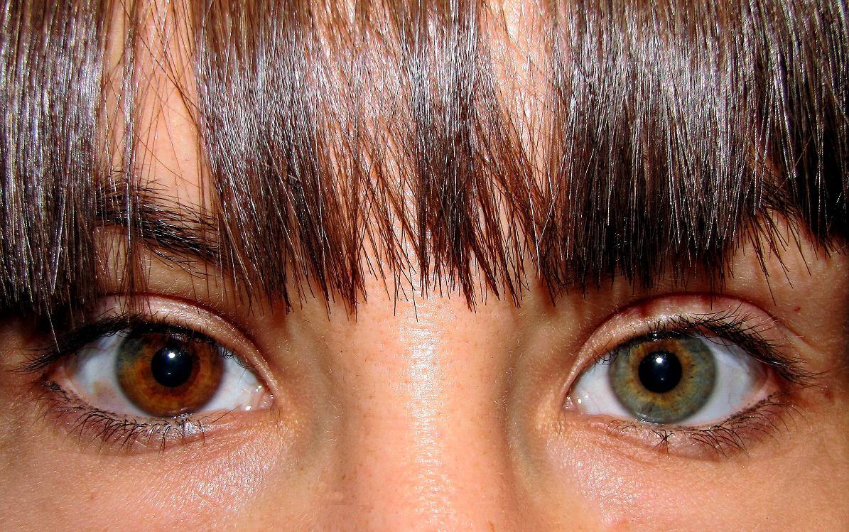 हेट्रोक्रोमिया (Heterochromia) : जानिए क्यों अलग होता है दोनों आंखो का रंग?