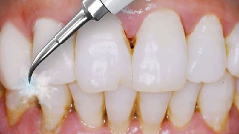 क्या होती है टीथ स्केलिंग (Teeth Scaling)? दांतों के लिए क्यों है जरूरी