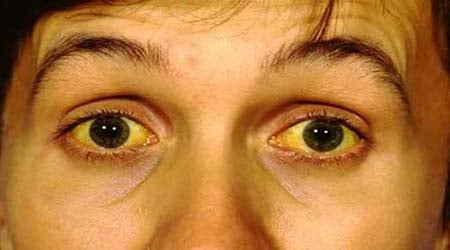 Jaundice: क्या होता है पीलिया? जानें इसके कारण लक्षण और उपाय