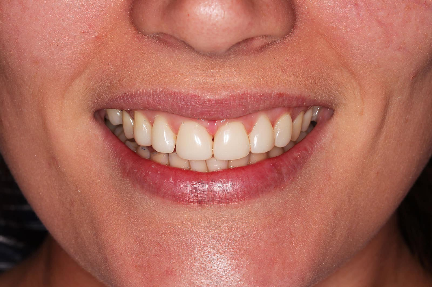 हेल्दी स्माइल पानें के आसान नुस्खे, क्योंकि मुस्कुराते चेहरे सबको होते हैं पसंद