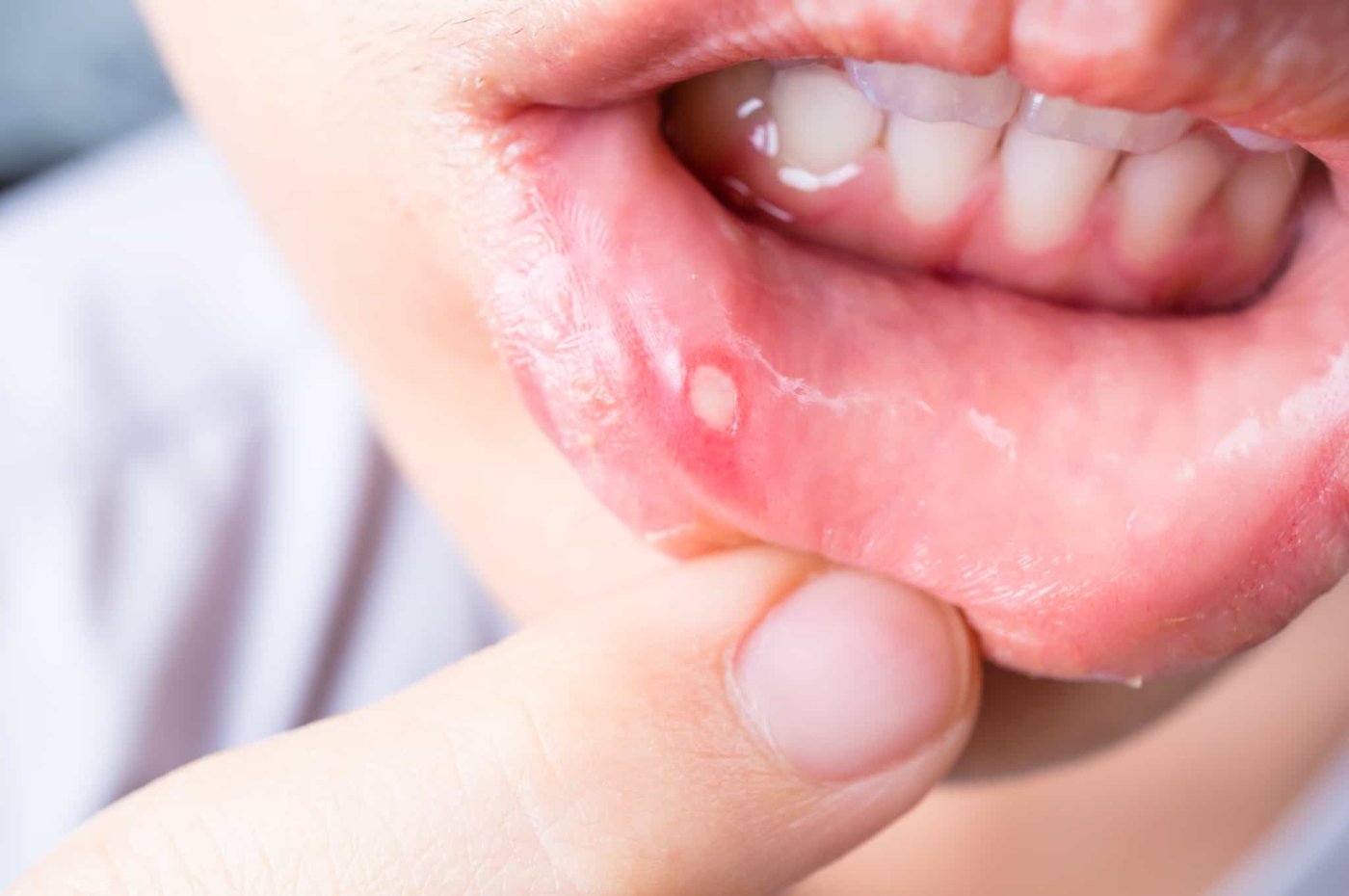 Mouth Ulcer: ये वजहें हो सकती हैं मुंह के छाले का कारण