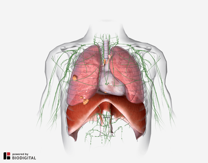 मेसोथेलियोमा लंग कैंसर के लक्षण मरीजों में इस तरह के नजर आ सकते हैं...