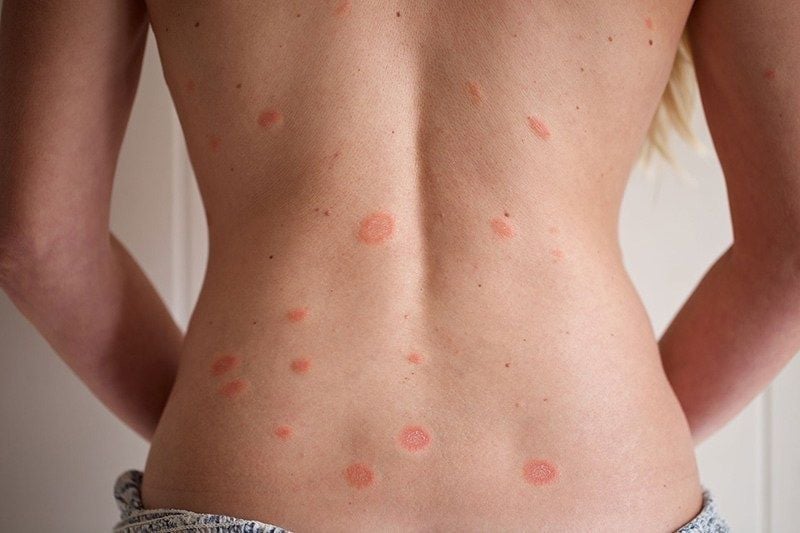 Pityriasis rosea: पिटिरियेसिस रोजिया क्या है?