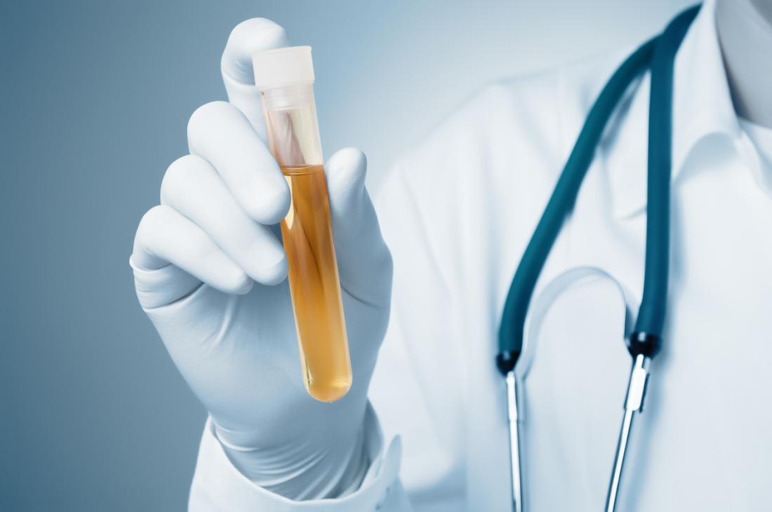 Urine Test : यूरिन टेस्ट क्या है?
