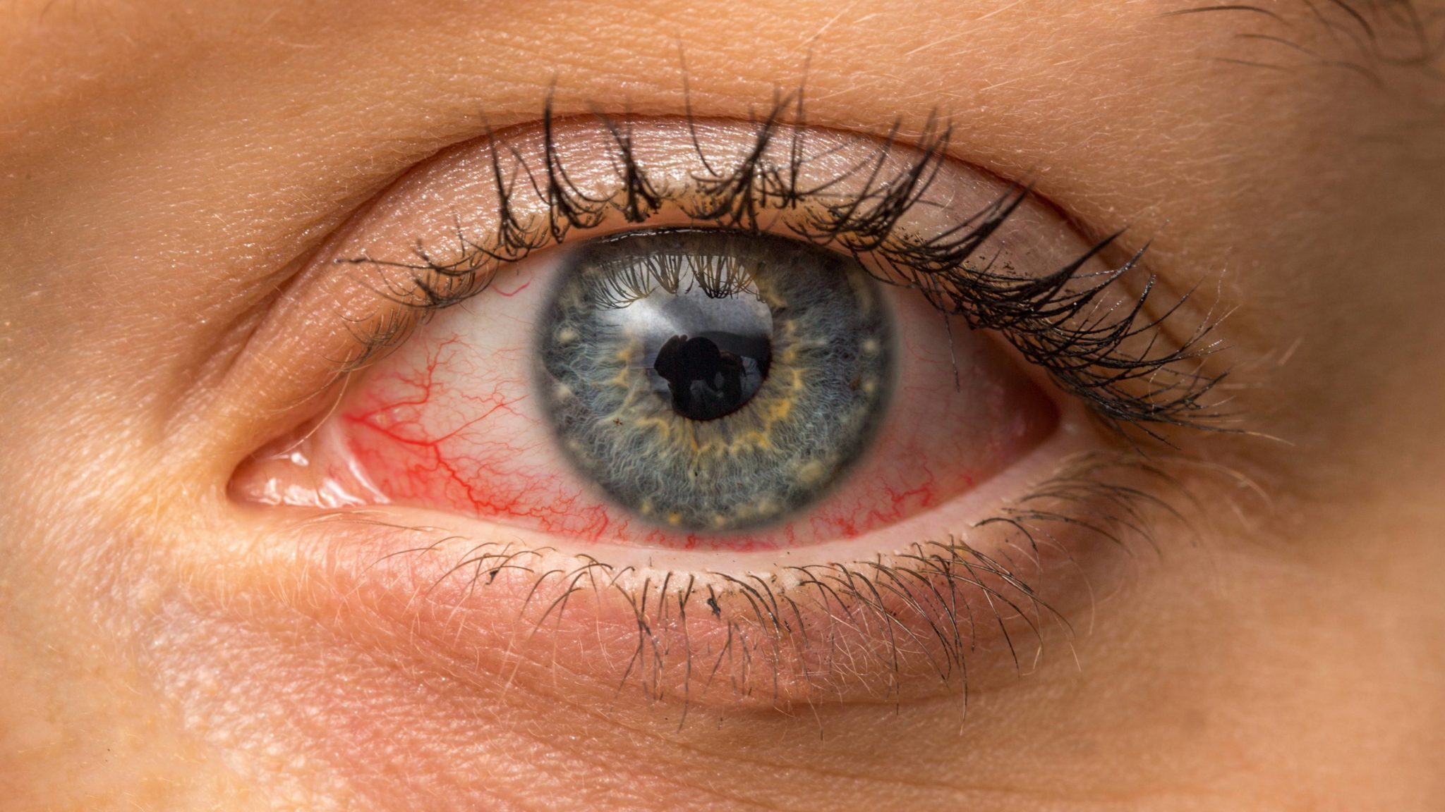 Conjunctivitis : कंजंक्टिवाइटिस क्या है? जानें इसके कारण, लक्षण और उपाय