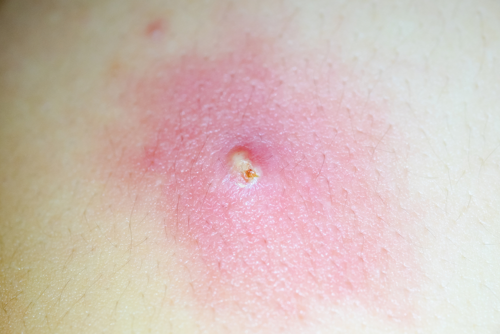 फोड़े फुंसियां दे रहे हैं तकलीफ, आजमाएं ये कारगर घरेलू इलाज