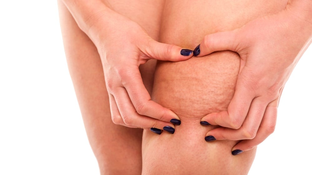 Cellulitis: सेल्युलाइटिस क्या है? जानें इसके कारण, लक्षण और इलाज