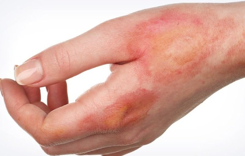 जली हुई स्किन का इलाज (Burned skin treatment) करने के लिए अपनाएं ये घरेलू उपाय