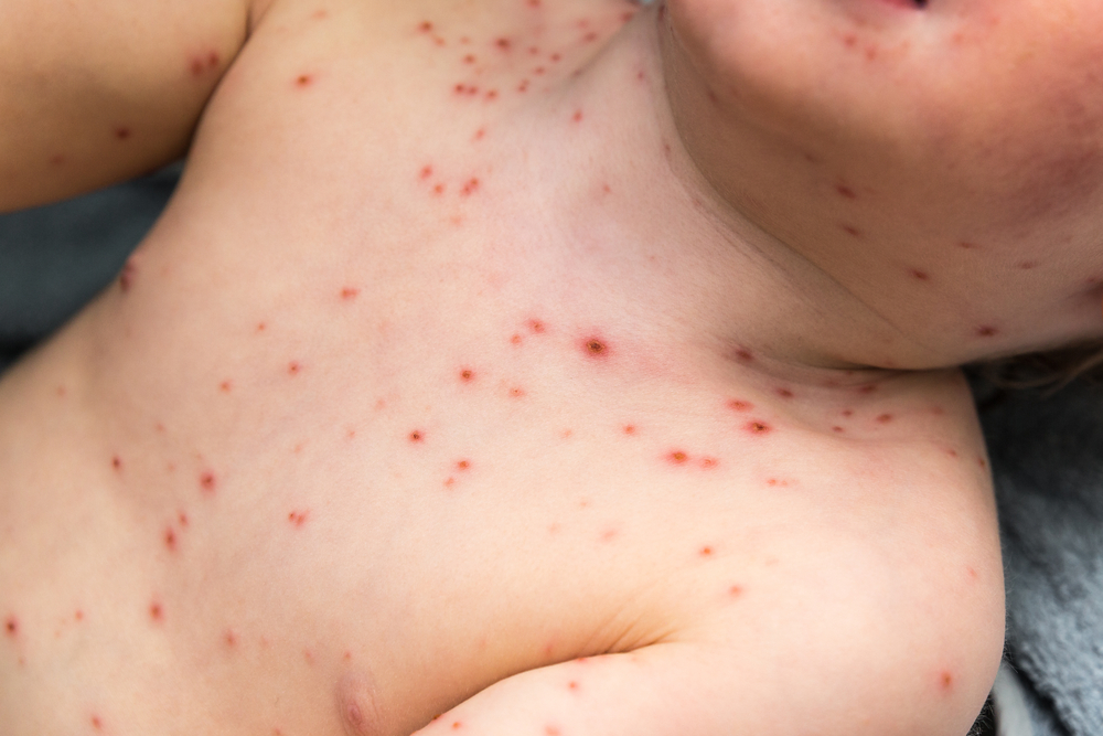 Chickenpox: चिकनपॉक्स क्या है? जानें इसके कारण, लक्षण और उपाय