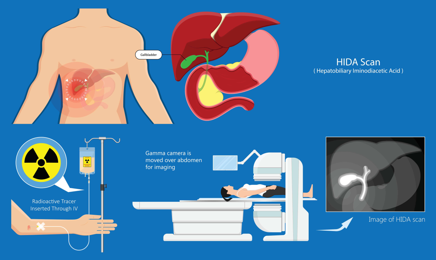 Hepatobiliary Iminodiacetic Acid (HIDA) Scan: हिडा स्कैन क्या है?