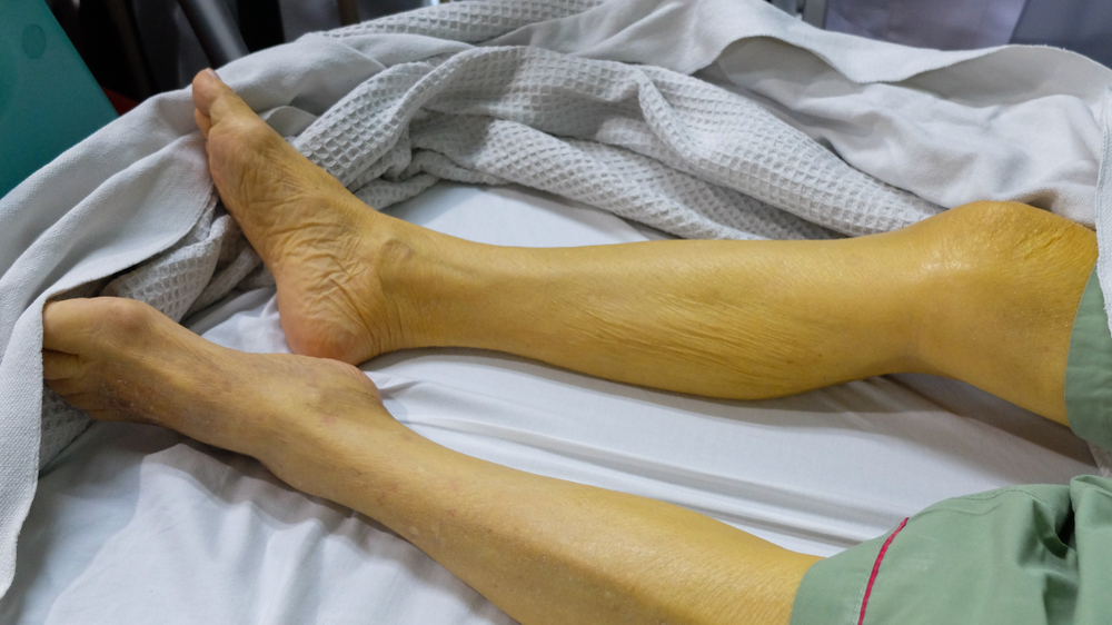 बाधक पीलिया (Obstructive Jaundice) क्या है?