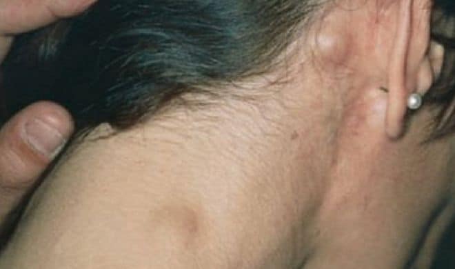 Lymphoma: लिम्फोमा क्या है? जानें इसके कारण, लक्षण और उपाय