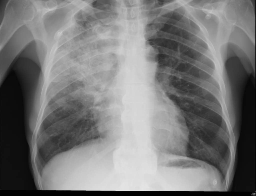 Pneumonia , निमोनिया