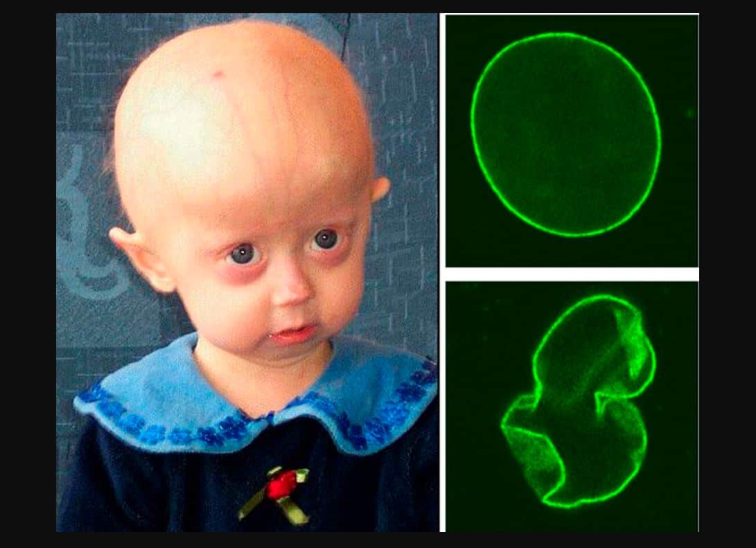 Progeria : प्रोजेरिया क्या है ?
