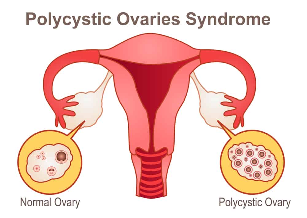 Polycystic Ovary Syndrome: पॉलीसिस्टिक ओवरी सिंड्रोम क्या है? जानें इसके कारण, लक्षण और उपाय
