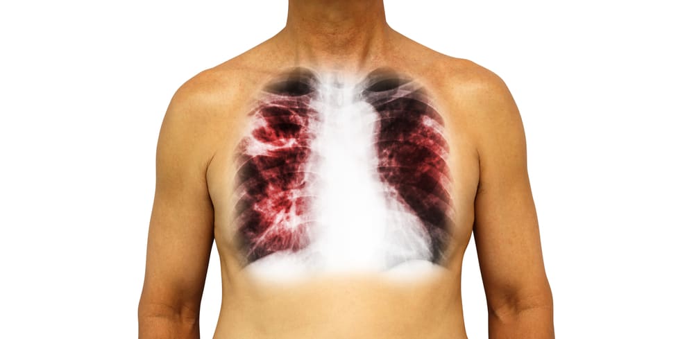 जानें क्या है फेफड़े की टीबी (Pulmonary Tuberculosis)?
