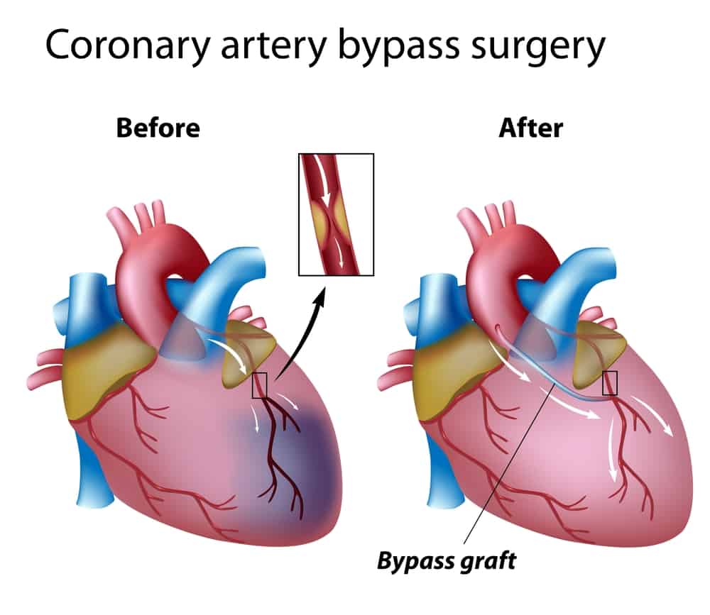 Coronary Artery Bypass Surgery: कोरोनरी आर्टरी बायपास सर्जरी क्या है?