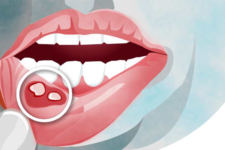 बार-बार होने वाले मुंह के छाले की वजह से हो सकता है कैंसर?