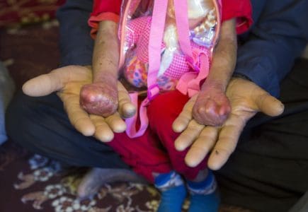 Epidermolysis Bullosa: एपिडर्मोलिसिस बुलोसा क्या है? जानिए इसके लक्षण और इलाज