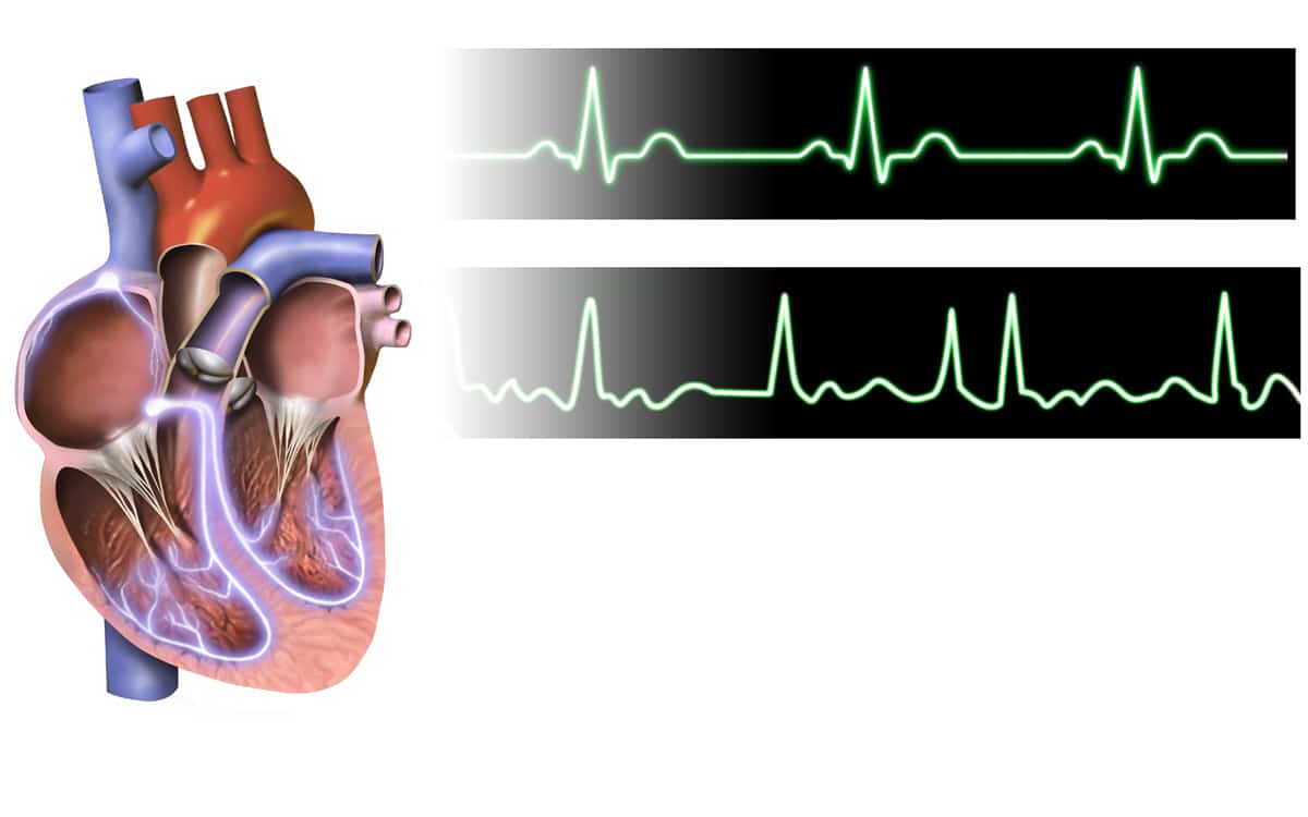 Atrial Fibrillation: एट्रियल फाइब्रिलेशन क्या है? जानिए इसके कारण, लक्षण और उपाय