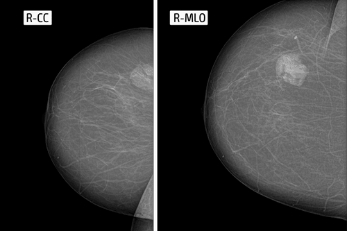 फाइब्रोएडीनोमा (Fibroadenoma) क्या है?