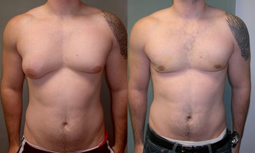 Gynecomastia : गाइनेकोमास्टिया क्या है?