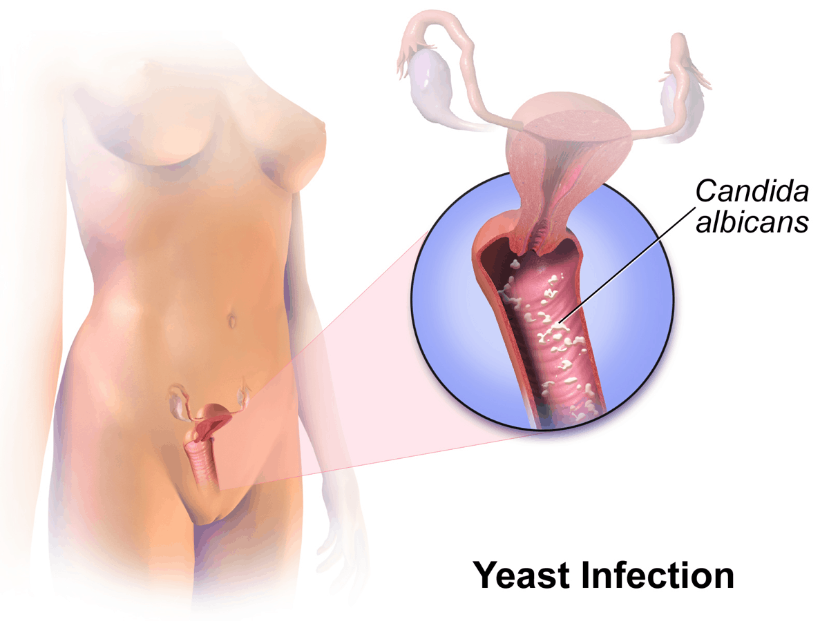 Bacterial Vaginal Infection : बैक्टीरियल वजायनल इंफेक्शन क्या है? जानें इसके कारण, लक्षण और उपाय