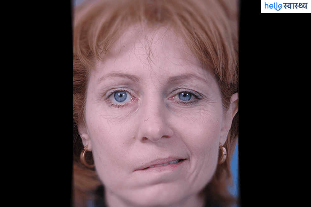 Bell's palsy: बेल्स पाल्सी क्या है?