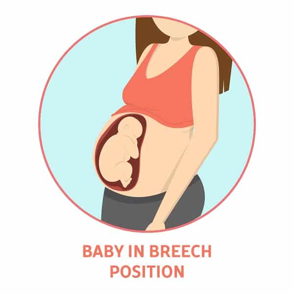 गर्भ में बच्चा उल्टा होना (Breech Presentation) क्या है? जानें प्रेग्नेंसी में क्या हैं इसके खतरे?