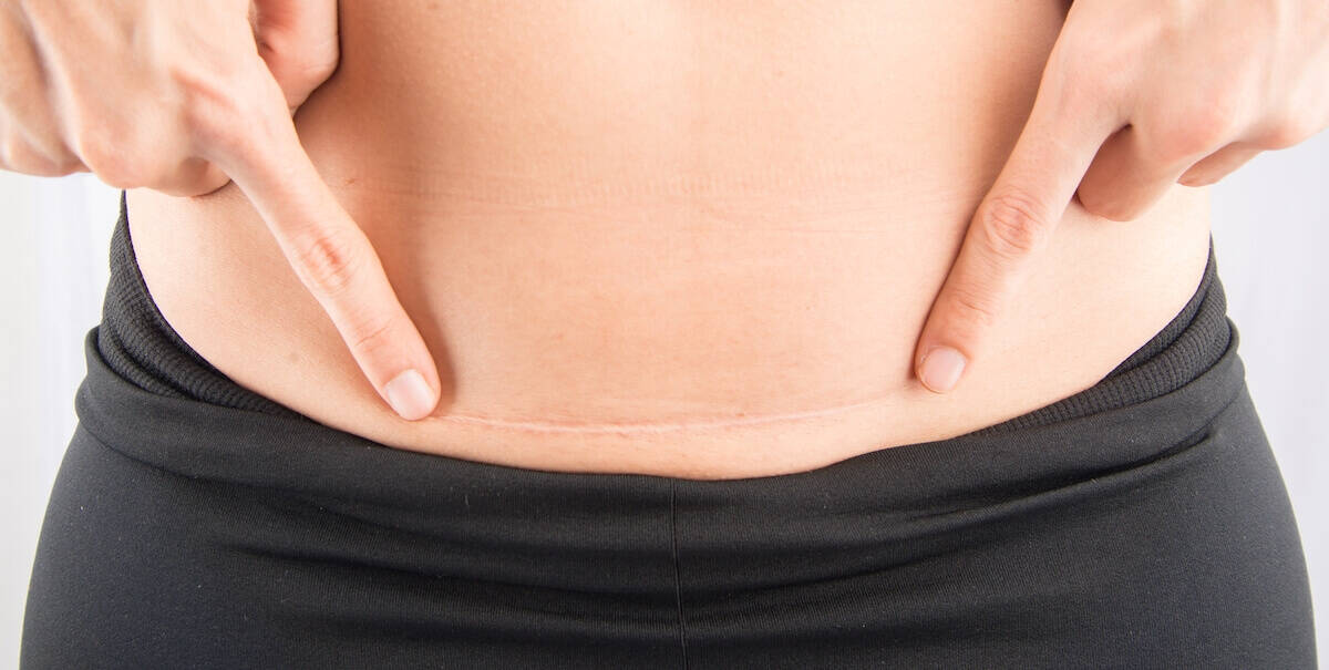 हुई है सिजेरियन डिलिवरी, ऐसे करें टांकों की देखभाल!