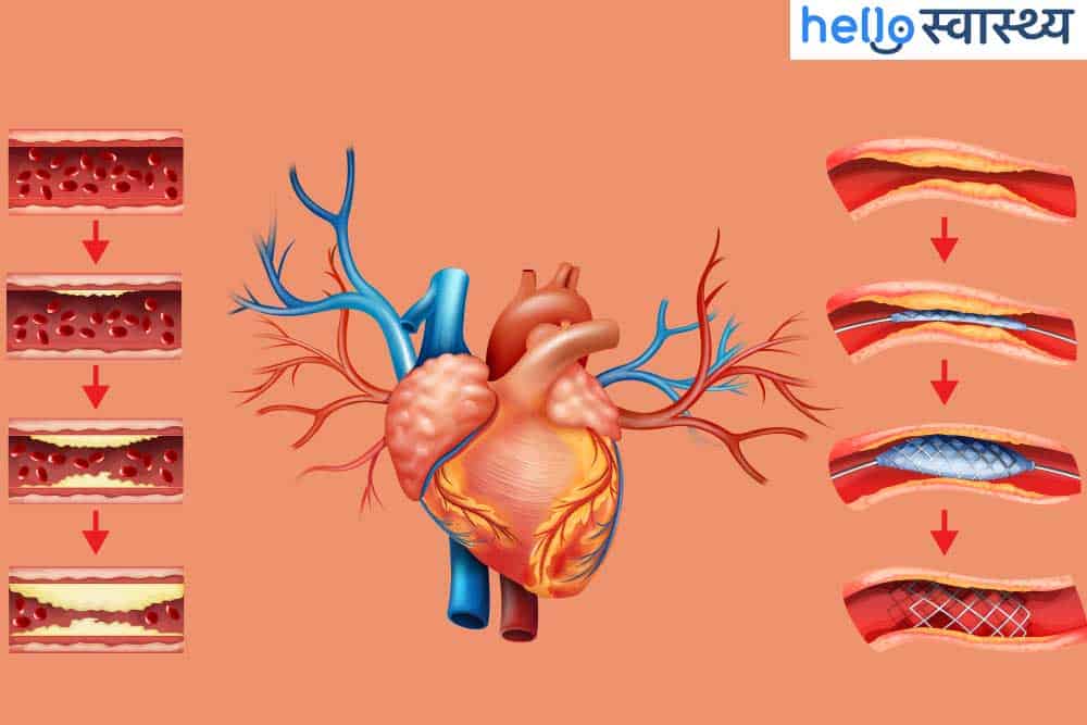 कोरोनरी एंजियोप्लास्टी (Coronary Angioplasty) क्या है?