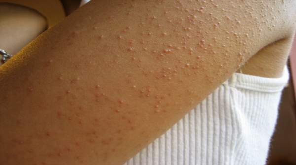 Keratosis pilaris: कैराटोसिस पाईलारिस क्या है?