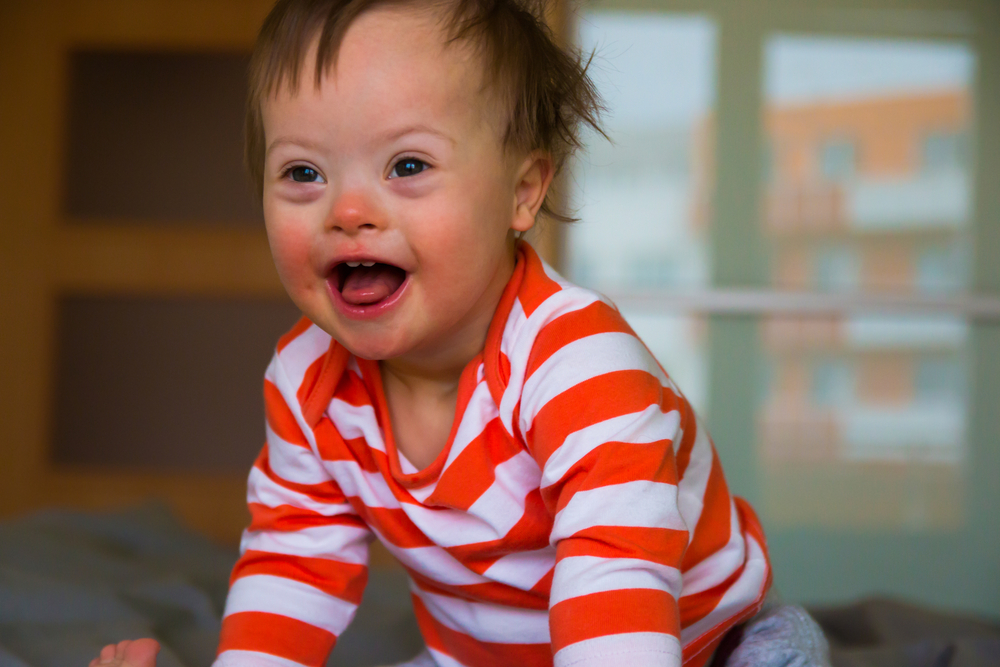 Down Syndrome - डाउन सिंड्रोम