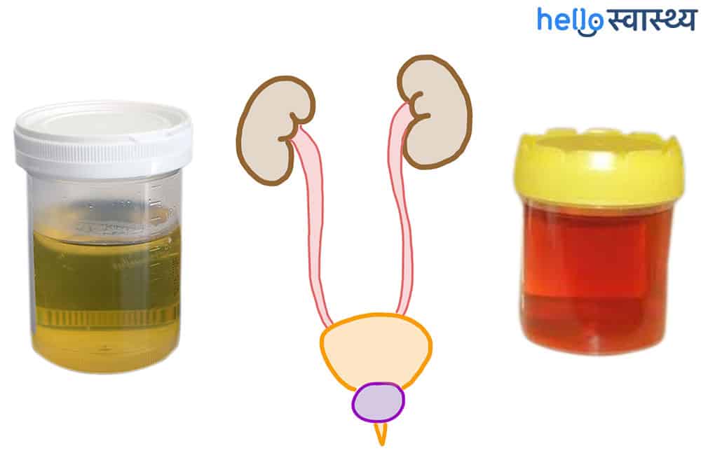 Hematuria: (हेमाट्यूरिया) पेशाब में खून आना क्या है? जानें इसके कारण, लक्षण और उपाय