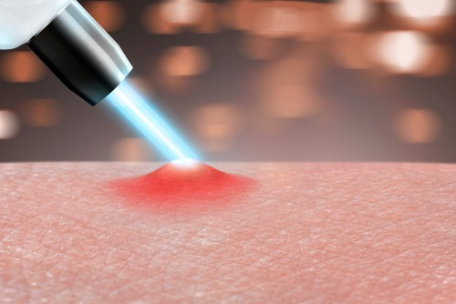 Laser acne treatment