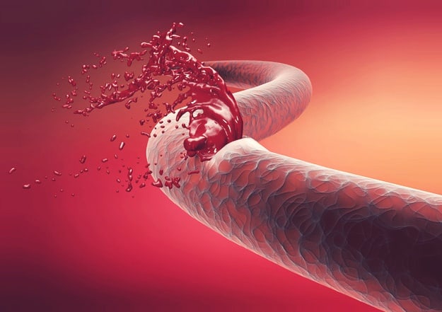 Hemophilia: हीमोफीलिया क्या है? जानें इसके कारण, लक्षण और उपाय