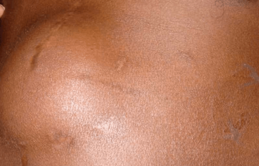 हर्निया से बचाव का क्या है विकल्प?