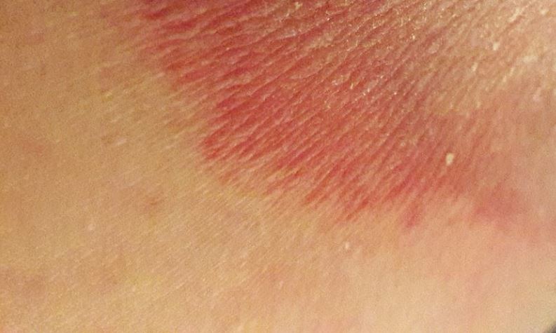 Jock Itch : जॉक इच (खुजली) क्या है?