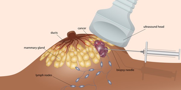Breast Biopsy: ब्रेस्ट बायोप्सी क्या है?