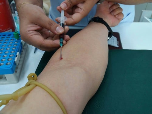 Haematocrit Test : जानें क्या है हिमाटोक्रिट टेस्ट?