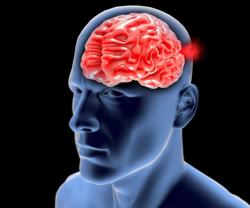 फाइब्रोमस्कुलर डिसप्लेसिया और स्ट्रोक का क्या संबंध है?