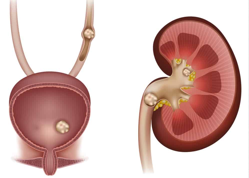 Bladder-stone: ब्लैडर स्टोन क्या है?
