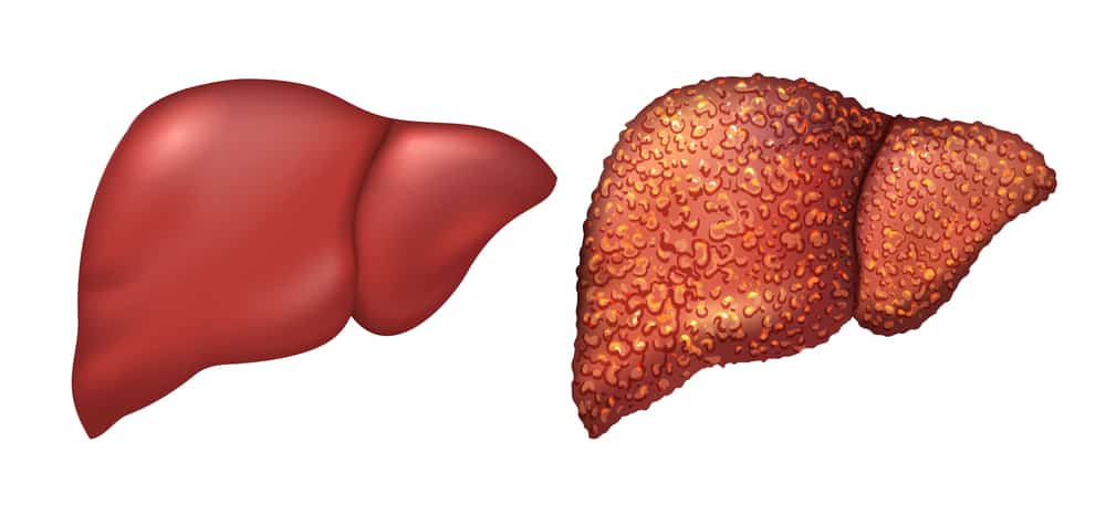 Liver cirrhosis: लिवर सिरॉसिस क्या है? जानिए इसके कारण, लक्षण और उपाय