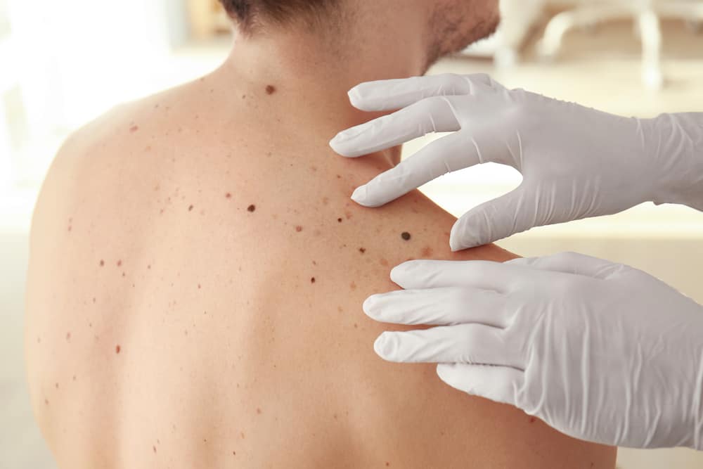 Melanoma (Skin Cancer): मेलेनोमा क्या है?
