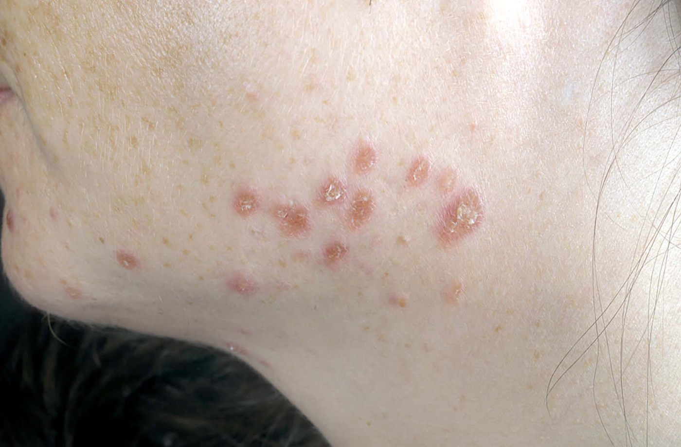 डर्मेटाइटिस (Dermatitis) क्या है?, जानें इससे जुड़ी सभी बातें